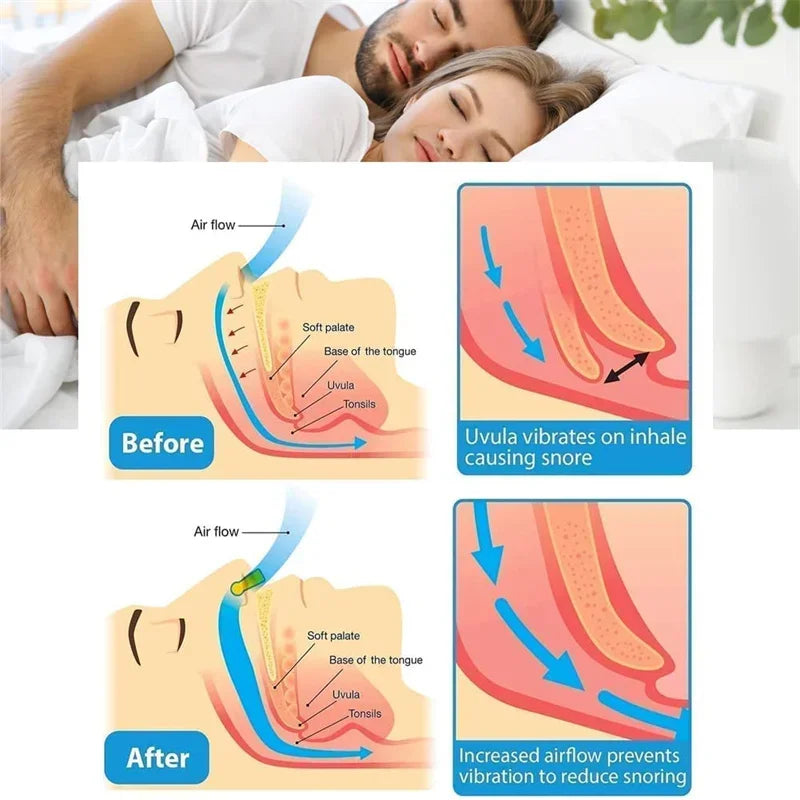 Anti-Snoring Corrector: Snore Prevention Gadget for Women & Men